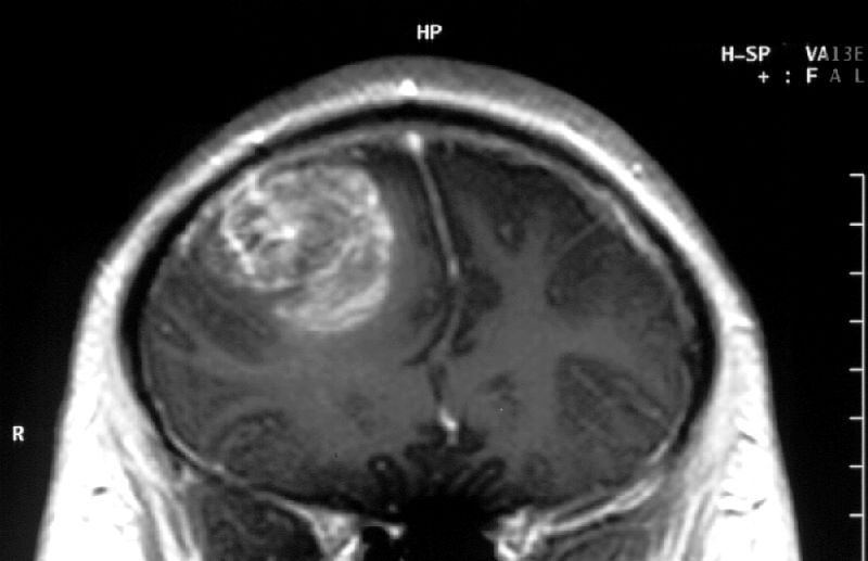 Renonancia magnética con un gioblastoma. Foto: Wikipedia